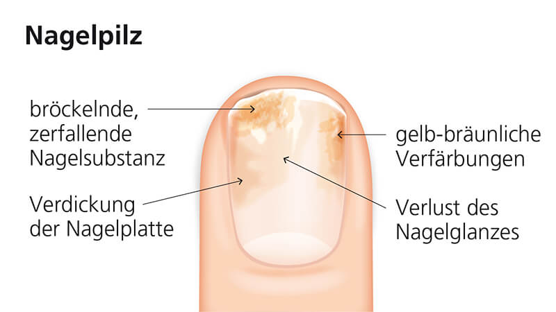 Nagelpilz Illustration